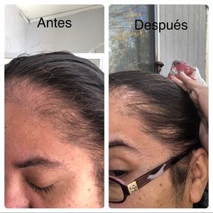 Voce Crescer Accessories Vc Hair Loss Treatment Shampoo 1 Month